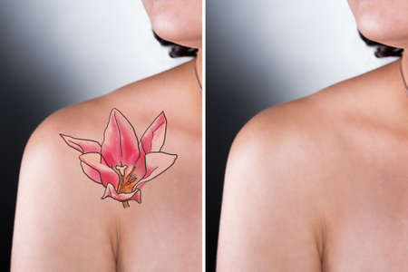 Shoulder Tattoo Removalの写真素材