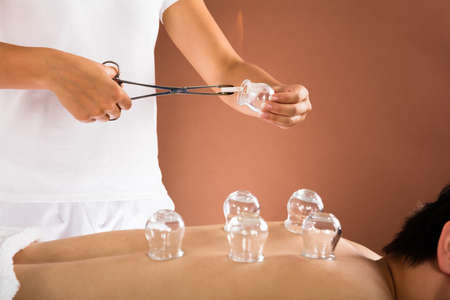 Close-up Of A Therapist Giving Cupping Therapy To Man In Spaの写真素材