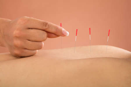 Close-up Of Person Receiving Acupuncture Treatment In A Beauty Spa