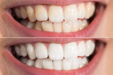 Close-up Detail Of Person Teeth Showing Before And After Whiteningの写真素材