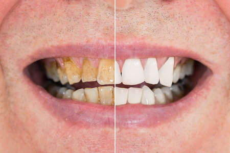 Close-up Detail Of Man Teeth Before And After Whitening