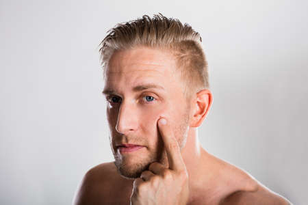 Man Squeezing Pimple On His Face. Acne Skin Problemの写真素材