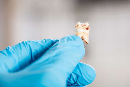 Close-up Of Dentist Hand In Glove Holding Decay Toothの写真素材
