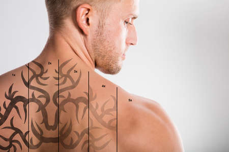 Laser Tattoo Removal On Shirtless Man's Back Against Grey Backgroundの写真素材