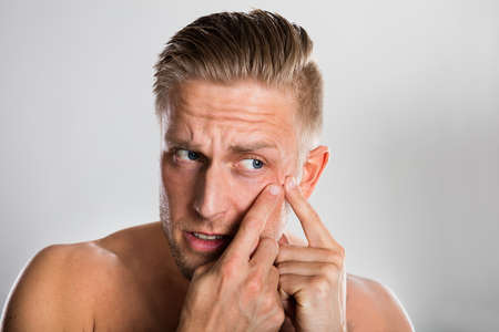 Man Squeezing Pimple On His Face Against Grey Background. Acne Skin Problemの写真素材
