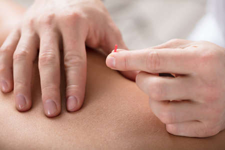 Close-up Of A Person Getting An Acupuncture Treatment At Spaの写真素材