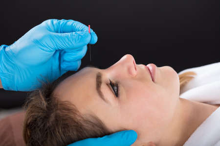 Close-up Of A Person Hand Putting Acupuncture Needle On Woman's Forehead At Spaの写真素材