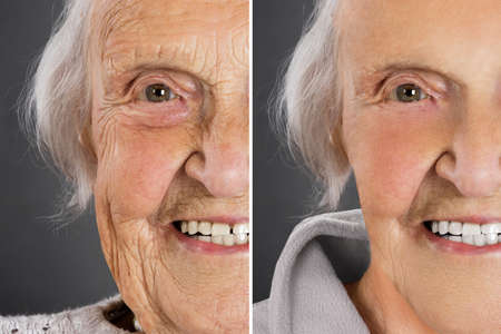 Senior woman anti aging skin treatment before and after