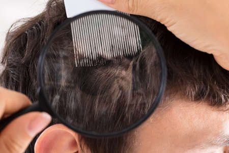 Close-up Of A Dermatologist's Hand Checking Patient's Hair With Magnifying Glass