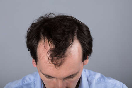 Close-up Of A Man's Head With Hair Loss Symptomsの写真素材