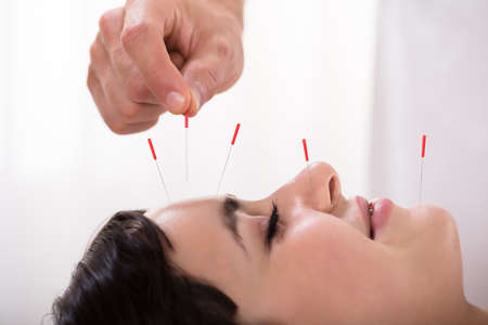 Beautiful Young Woman Getting Acupuncture Treatment In Beauty Spaの写真素材