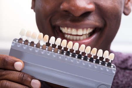 Close-up Of A Smiling Man Matching The Shades Of The Implant Teethの写真素材