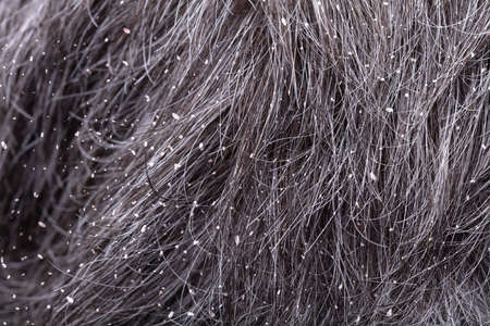 Full Frame Shot Of A Man's Hair With Dandruffの写真素材