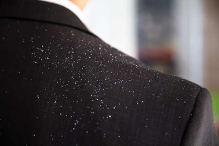 Close-up Of A Businessperson With Dandruff On His Shoulderの写真素材