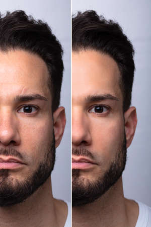 Man's Face Before And After Cosmetic Procedure On Grey Backgroundの写真素材