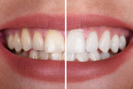 Close-up Of A Smiling Woman's Teeth Before And After Whitening