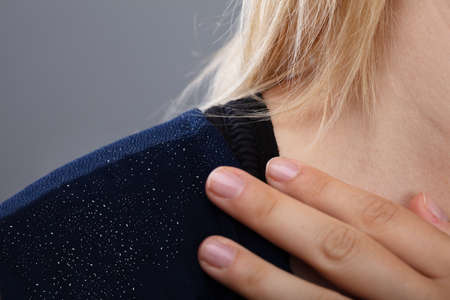 Close-up Of A Woman's Shoulder With Dandruffの写真素材