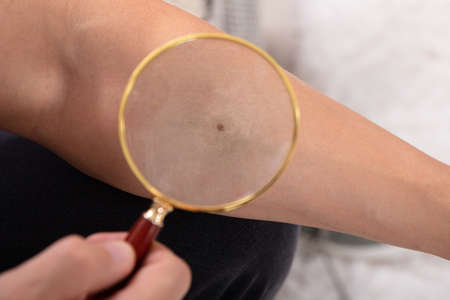 Close-up Of A Man Examining Mole On His Hand With Magnifying Glass