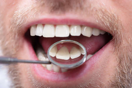 Close-up Of A Man Having Dental Check Up With Dentist Mirror