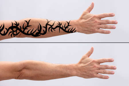 Laser Tattoo Removal On Man's Hand Against White Backgroundの写真素材