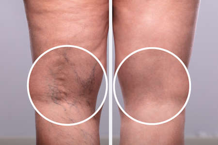 A Person Knee's With Varicose Veins And Capillaries Before And After Medical Treatment