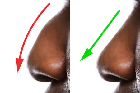 Woman's Nose Before And After Plastic Surgery With Red And Green Arrowsの写真素材