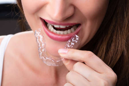 Close-up Of A Woman's Hand Putting Transparent Aligner In Teeth