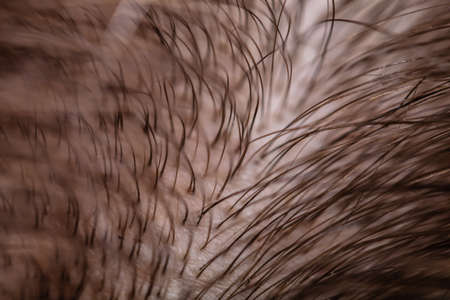 Macro Shot Of Thinning Hair On Headの写真素材