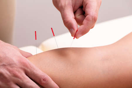 Close-up Of A Therapist Giving Acupuncture Treatment By Inserting Needles On Woman's Kneeの写真素材