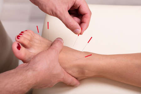 Woman Undergoing Acupuncture Treatment With Fine Needles Inserted Into The Skin Of Her Footの写真素材
