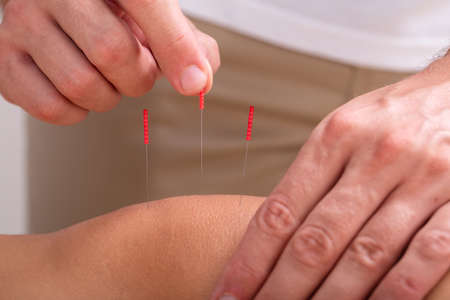 Close-up Of Acupuncturist's Hand Pricking Acupuncture Needles On Person's Knee In Clinicの写真素材