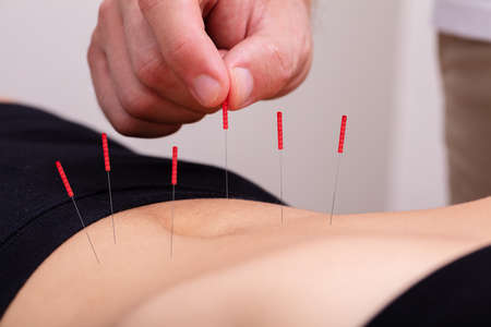 Close-up Of Doctor's Hand Perform Medical Professional Acupuncture Treatment In Beauty Spa On Woman's Bodyの写真素材