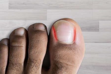 High Angle View Of Sore Toe Nail On Floor