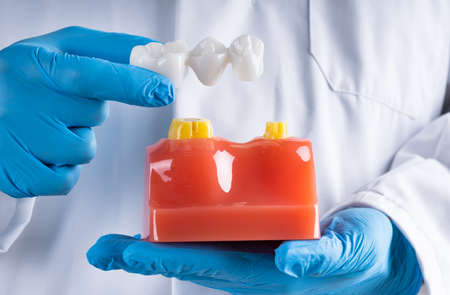 Dentist In Gloves Showing Dental Tooth Bridge Model