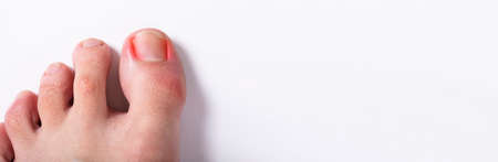 Ingrown Toenail. Infected And Sore Nail Problem