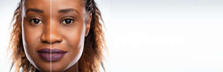 Before And After Black Woman Face Laser Microdermabrasion