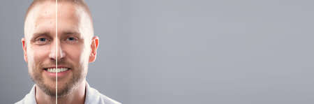 Before After Laser Skin Wrinkle Remove On Manの写真素材