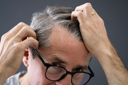 Balding Man Losing Hair. Checking Scalp Hair Lossの写真素材