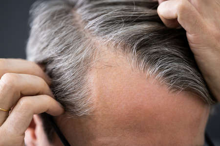 Balding Man Losing Hair. Checking Scalp Hair Loss
