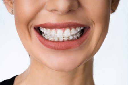 Female Mouth With Metal White Dental Braces Or Brackets