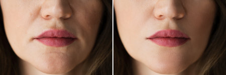Anti Age Rejuvenation Lips Lift Before And Afterの写真素材