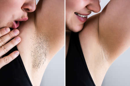 Before After Laser Hair Removal And IPL