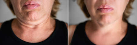 Double Chin Face Injection And Plastic Surgery