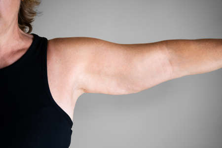 Overweight Lady Arm With Excess Fat. People Obesityの写真素材