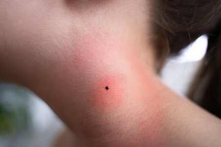 Encephalitis Mite Bug Or Arachnid Parasite Under Child Skinの写真素材