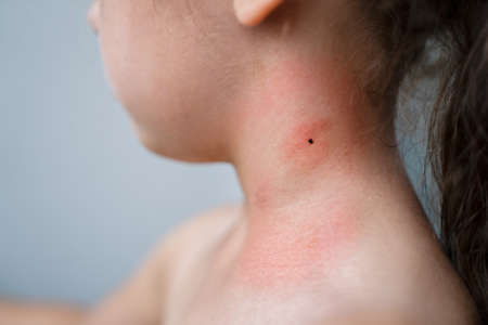 Encephalitis Mite Bug Or Arachnid Parasite Under Child Skin