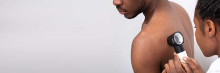 Close-up Of A Female Doctor Checking Pigment Skin On Man's Back With Dermatoscopeの写真素材