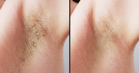 Before And After Concept Of Woman's Underarm Hair Removal On Grey Backgroundの写真素材