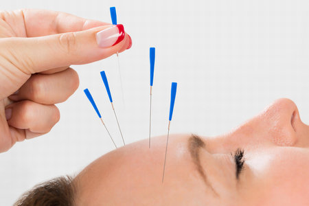 Close-up Of Young Beautiful Woman Receiving Acupuncture Treatmentの写真素材