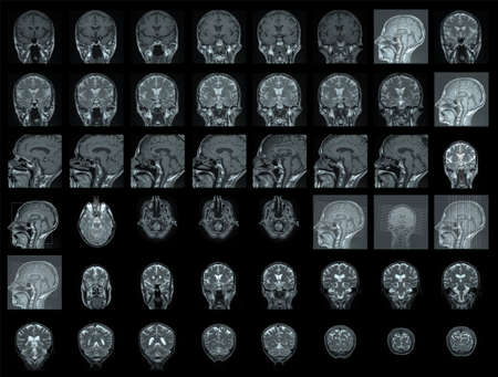 MRI of human brain の写真素材